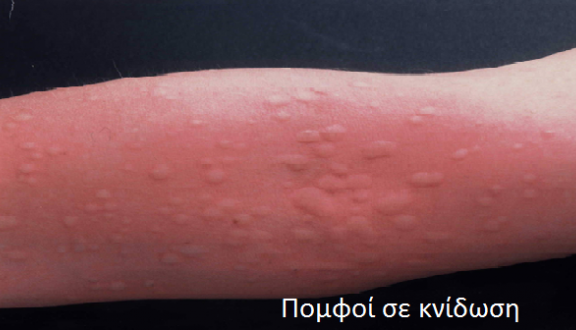 παγκόσμια-ημέρα-κνίδωσης-τι-πρέπει-να