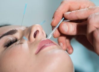 πόσο-βοηθάει-ο-βελονισμός-στη-διακοπή